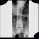 Aneurysm of abdominal aorta on plain radiograph, stent: X-ray - Plain radiograph